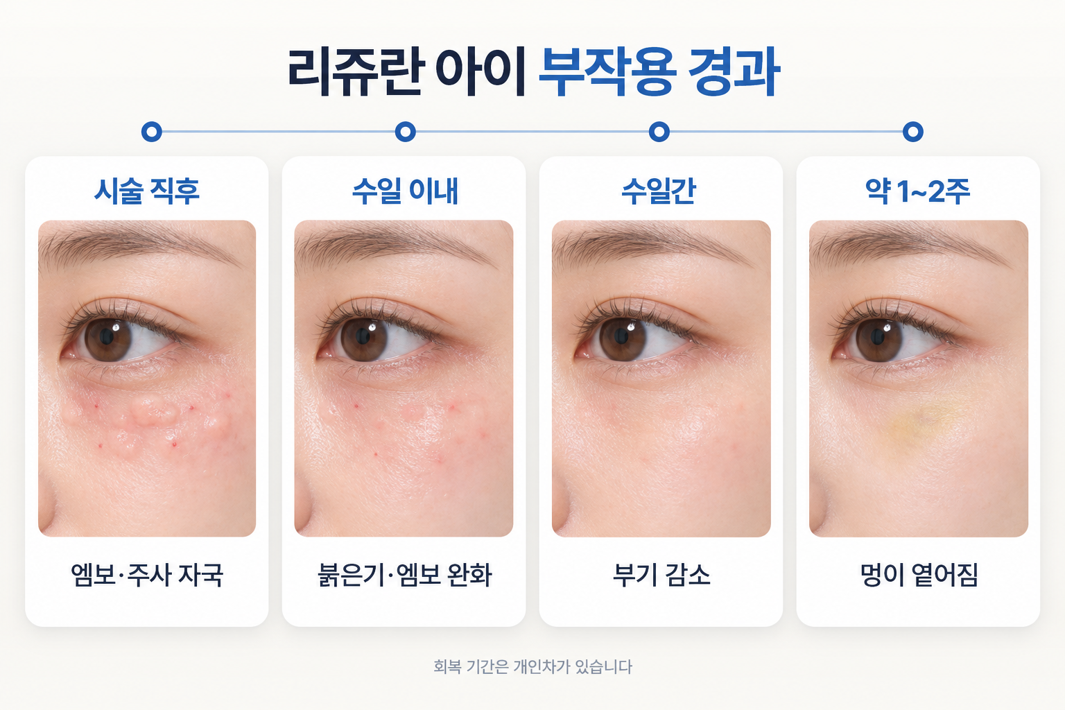 멍·부기·요철감에 대한 불릿과 개인별 회복 기간 차이를 설명한 마지막 문단 아래