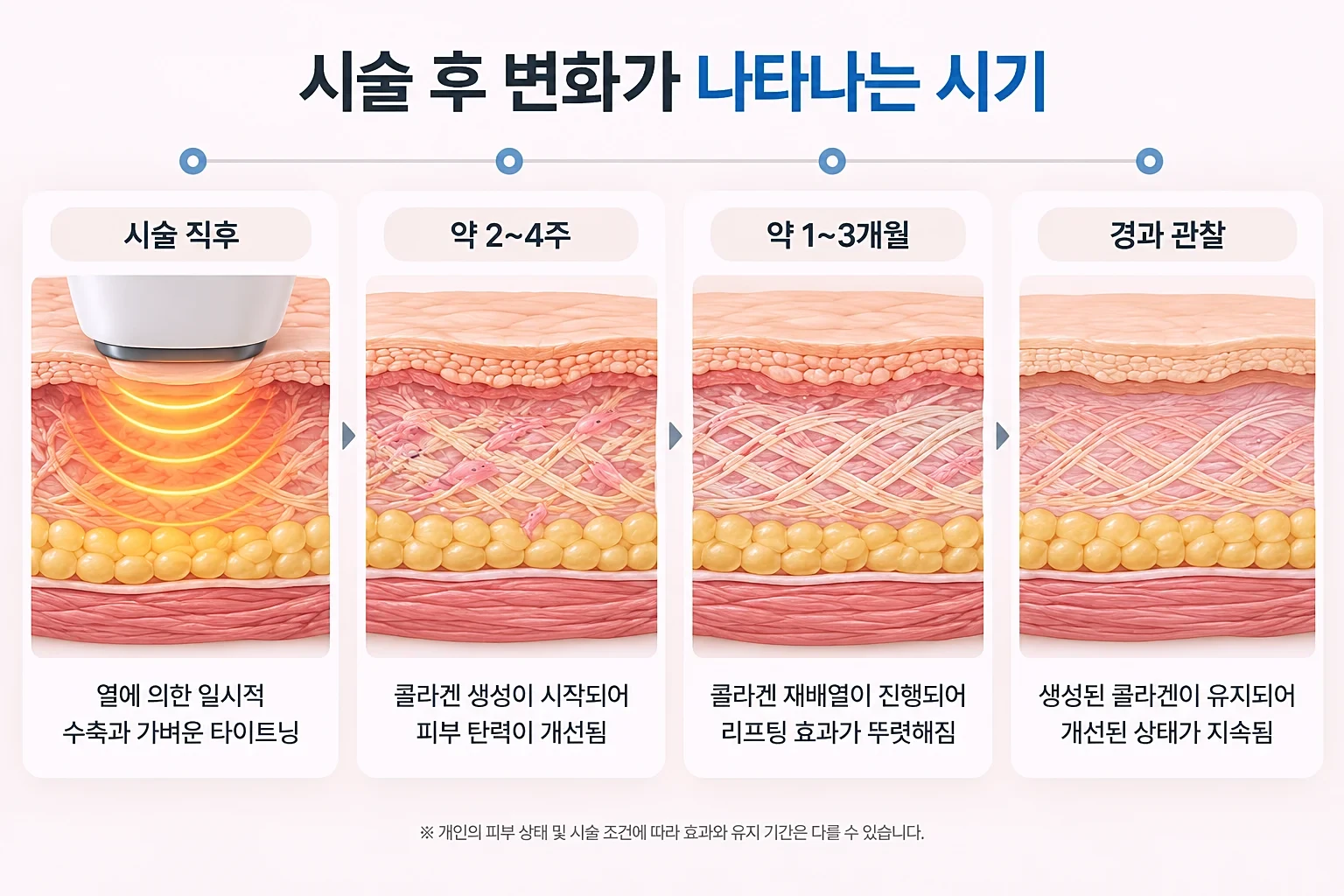 시술 직후부터 1~3개월까지 콜라겐 재배열과 조직 수축 변화를 정리한 시기별 흐름