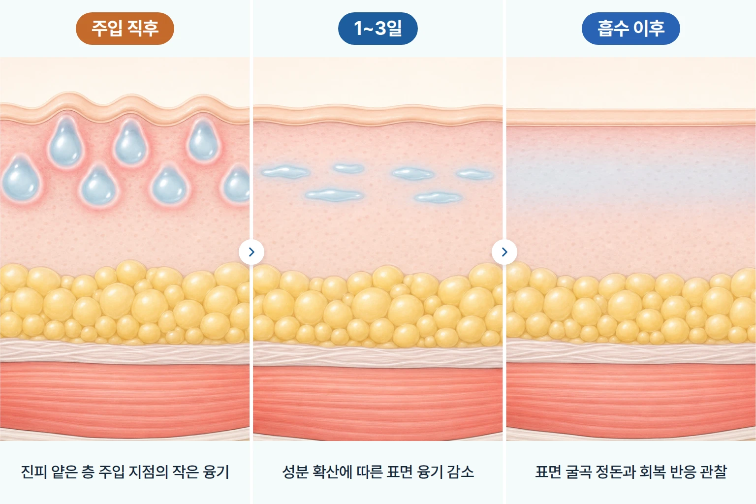 리쥬란 힐러 주입 직후 엠보싱 