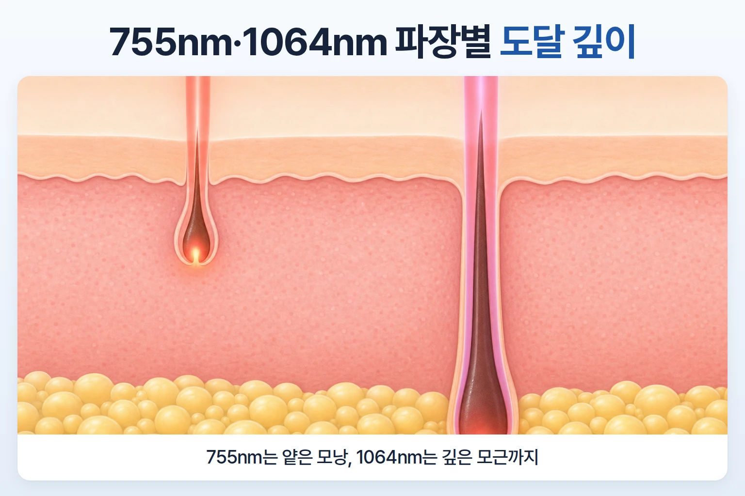 755nm와 1064nm 파장이 얕은 모낭과 깊은 모근에 닿는 깊이 차이를 비교한 피부 단면도