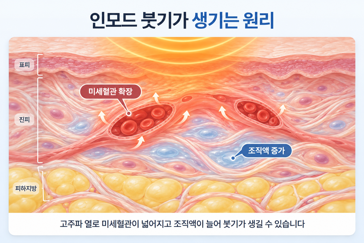 고주파 열에 따른 피부 진피층의 미세혈관 확장과 조직액 증가, 피하지방층을 포함한 피부 단면 구조