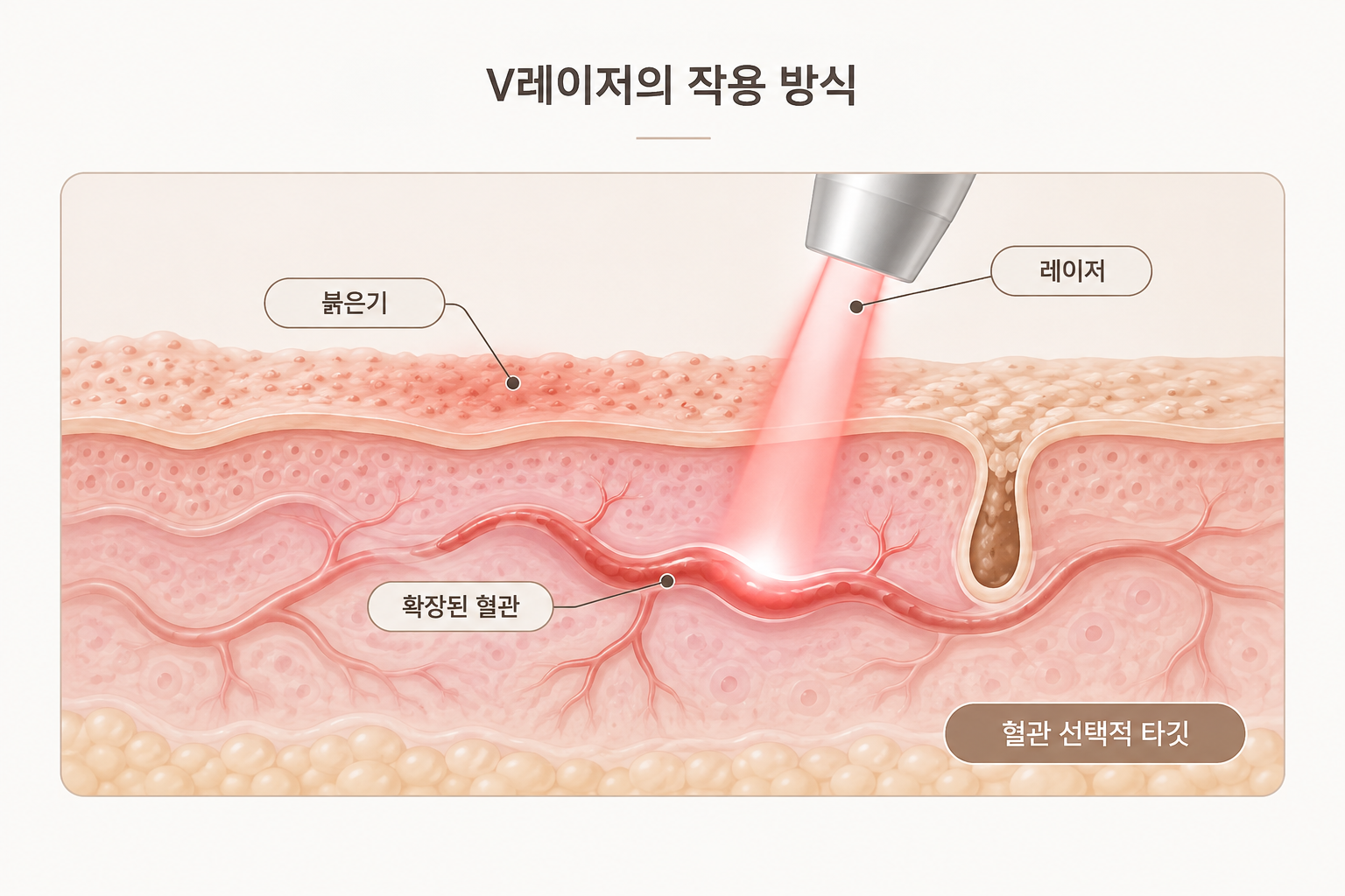 모공각화증 붉은기의 원인이 되는 확장 혈관을 선택적으로 타깃하는 V레이저 원리
