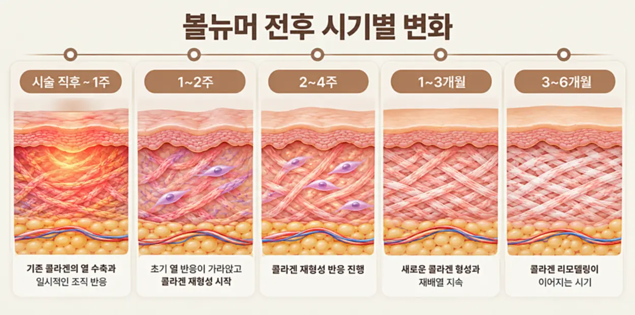 볼뉴머 전후 효과 나타나는 시기별 변화를 나타내는 이미지