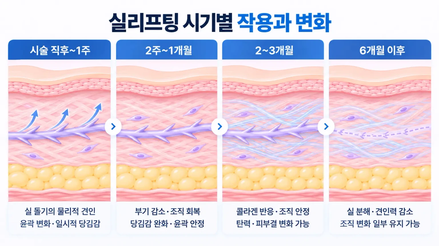 실리프팅 시기별 작용과 변화를 설명하는 피부과 의료 인포그래픽. 시술 직후 물리적 견인부터 2주~1개월