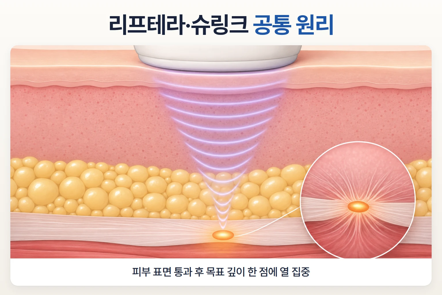 집속초음파가 피부 표면을 지나 목표 깊이에 집중되어 열응고점을 형성하는 HIFU 리프팅의 피부층 단면 구조