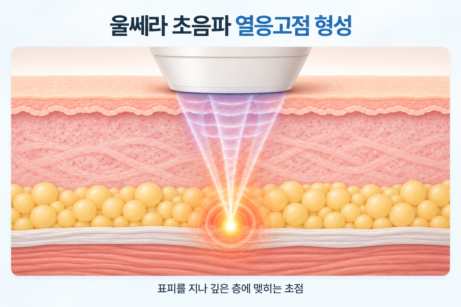 울쎄라 초음파 에너지가 피부 깊은 층에 열응고점을 형성하는 원리