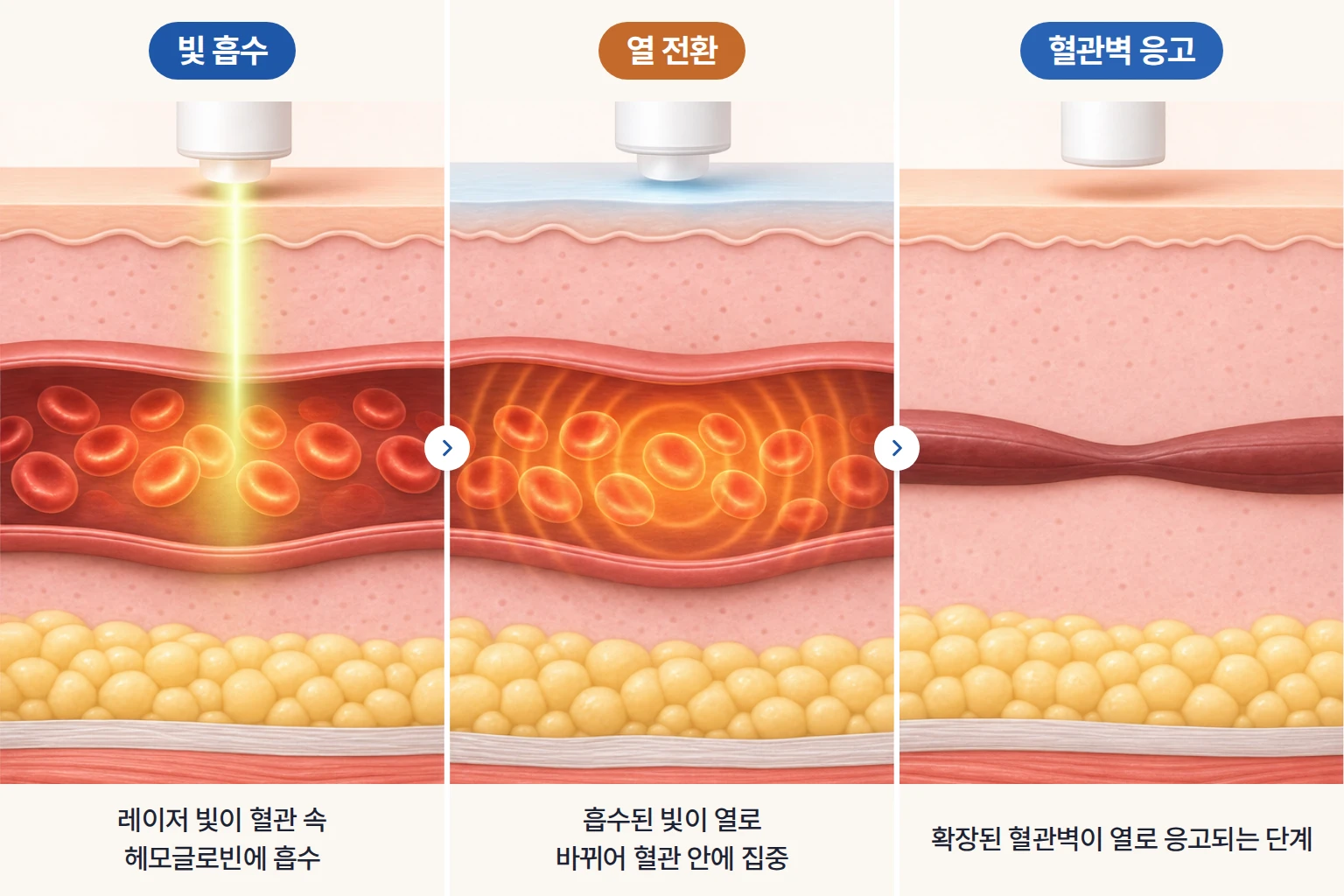 레이저 빛 흡수, 열 전환, 확장된 혈관벽 응고 과정을 단계별로 나타낸 혈관 레이저 개념도