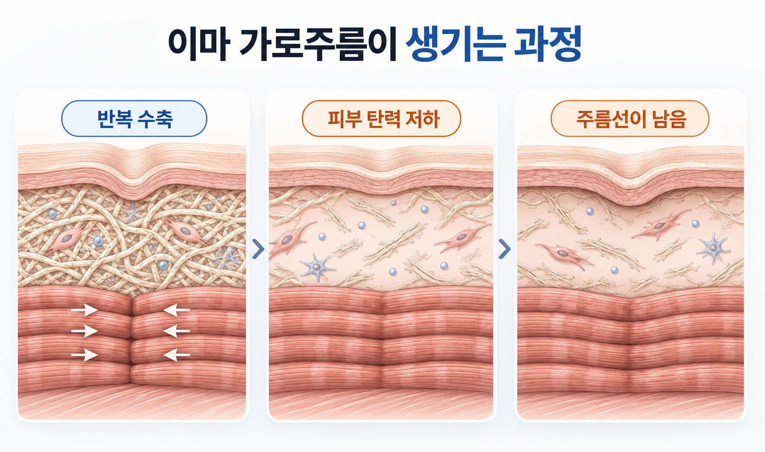 전두근 반복 수축과 피부 탄력 저하로 이마 가로주름이 남는 과정