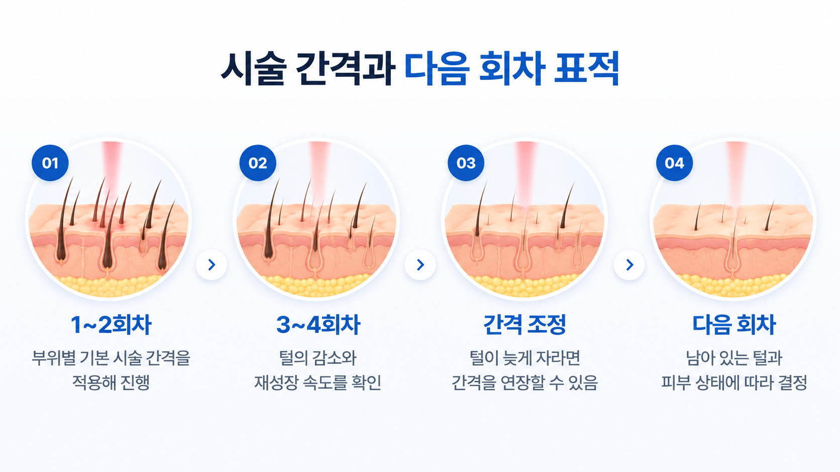 레이저제모 1~2회차 기본 시술 간격부터 3~4회차 털의 재성장 확인, 남은 털과 피부 상태에 따른 다음 시술 간격 조정