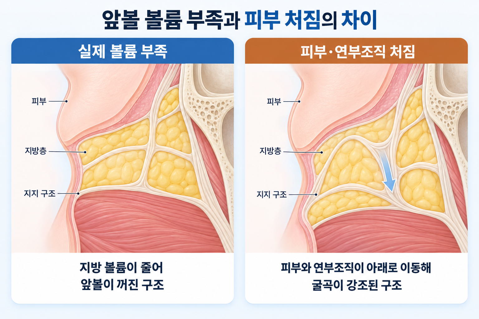 앞볼 꺼짐 원인인 지방 볼륨 부족과 피부·연부조직 처짐의 단면 비교, 지방층 감소와 조직 이동에 따른 굴곡 차이