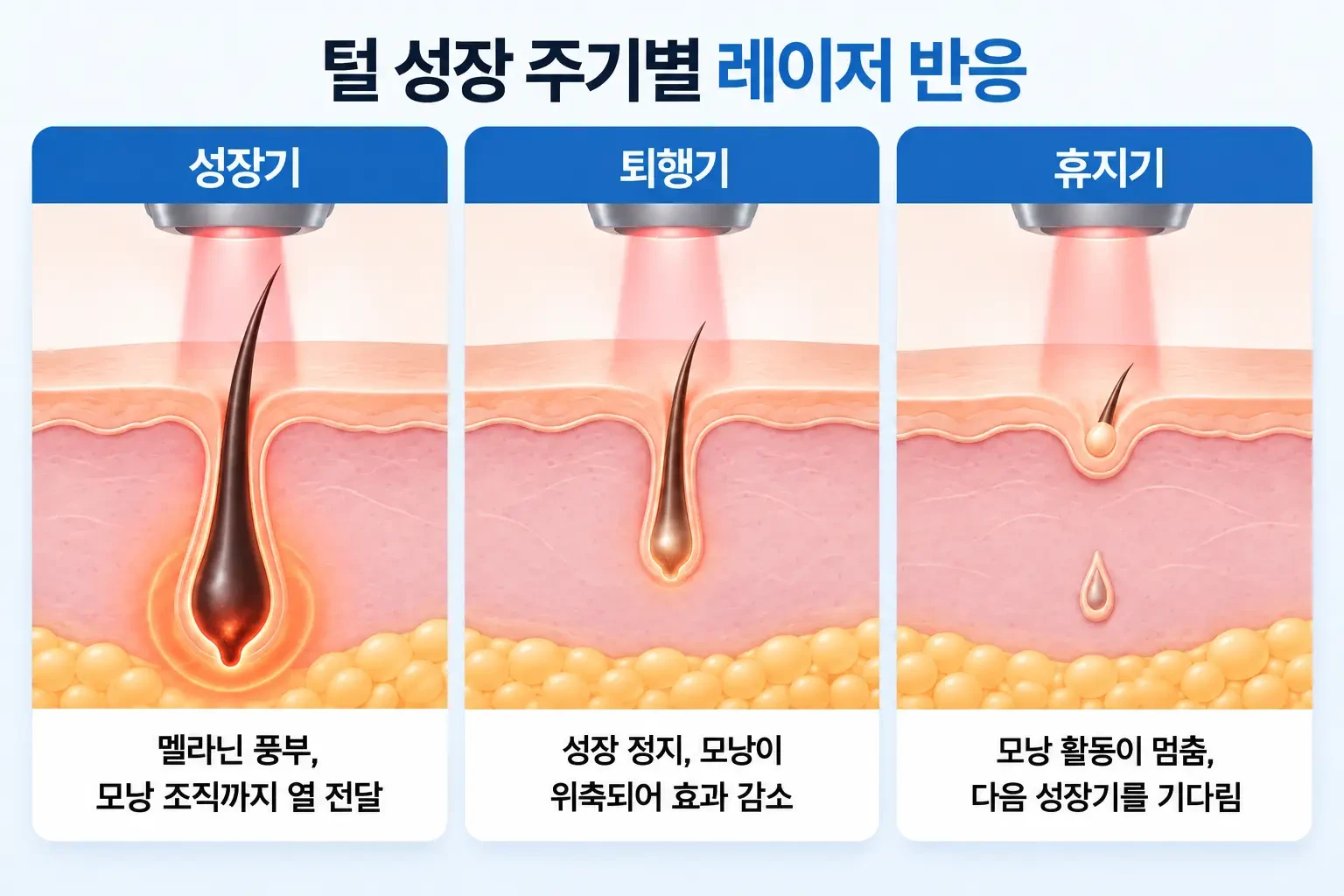 성장기, 퇴행기, 휴지기 모낭 중 성장기 털의 멜라닌에 레이저 열이 모이는 모습을 비교한 개념도