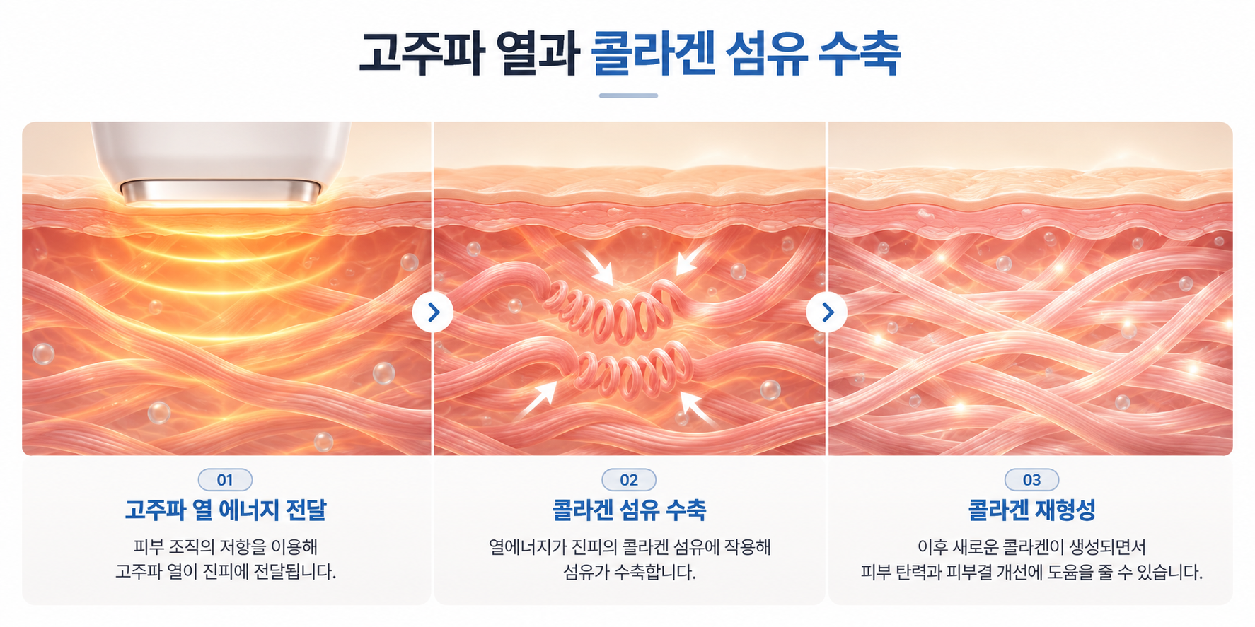 고주파 열에너지 전달과 콜라겐 섬유 수축 및 재형성 과정