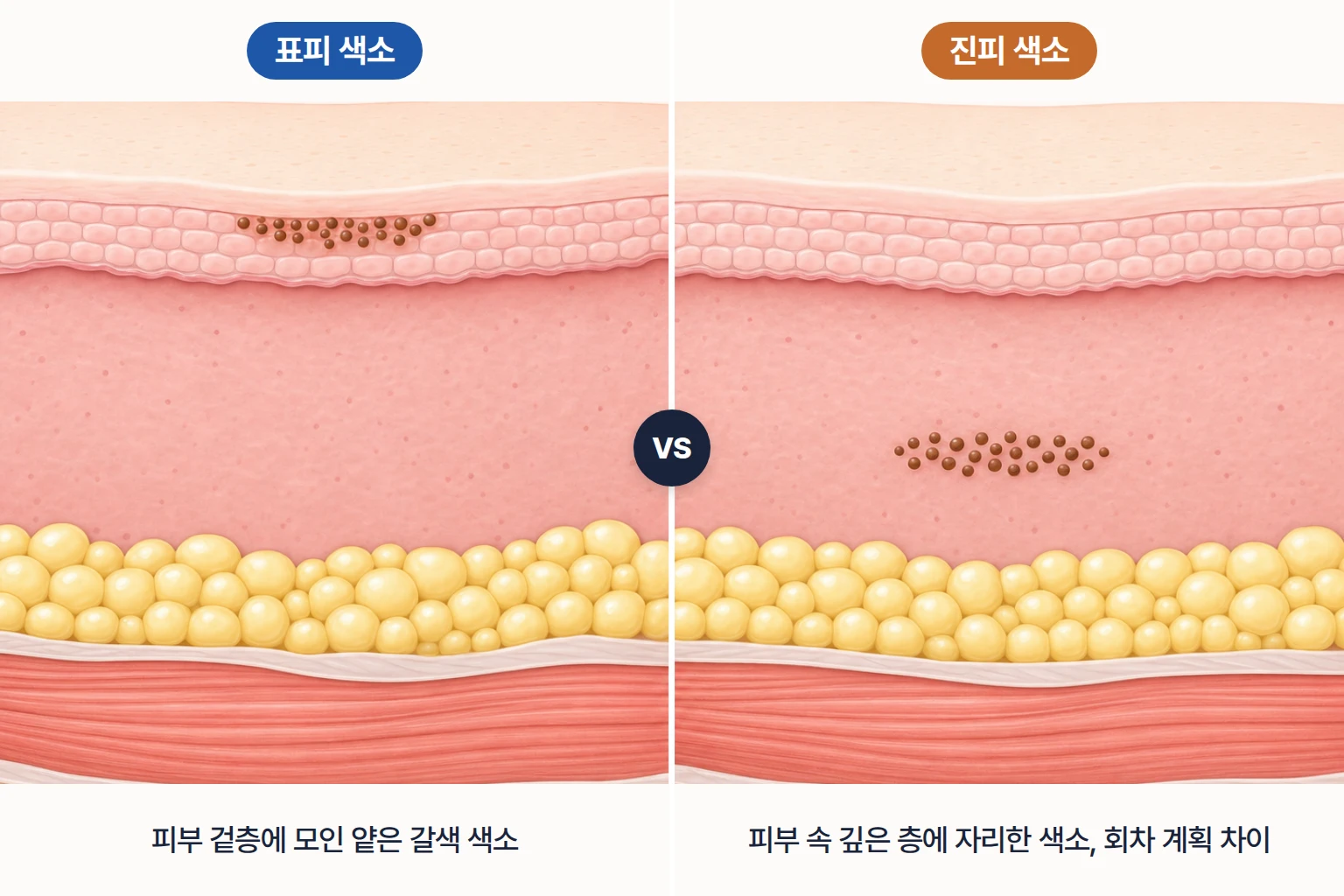 같은 갈색 색소가 표피 얕은 층과 진피 깊은 층에 자리한 모습을 비교한 피부 단면 모식도