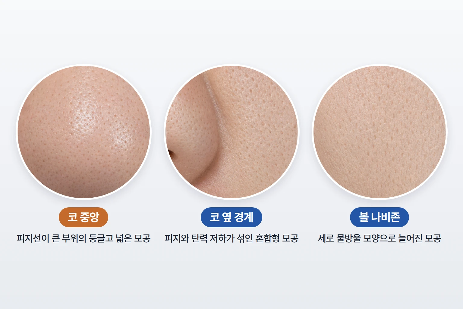 코 중앙, 코 옆, 볼 나비존의 모공 모양 차이를 같은 배율로 나란히 담은 피부 확대 비교 사진