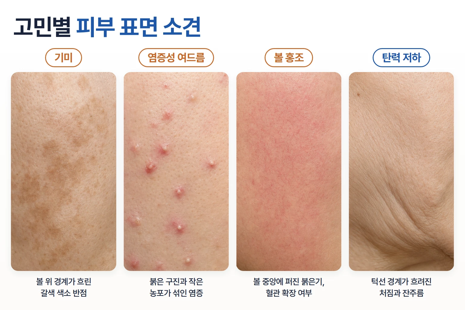 기미, 염증성 여드름, 볼 홍조, 탄력 저하 처짐의 피부 표면을 네 칸으로 나란히 놓은 비교 사진