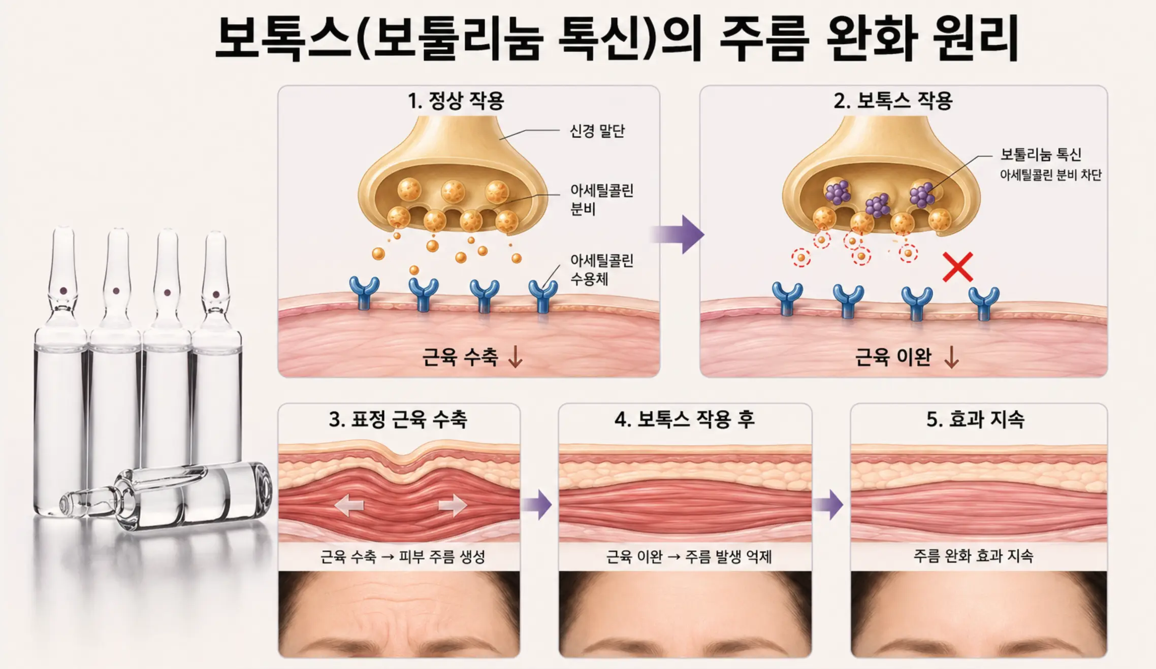 보툴리눔 톡신의 신경전달물질 아세틸콜린 분비 차단 및 주름 완화 원리 도해