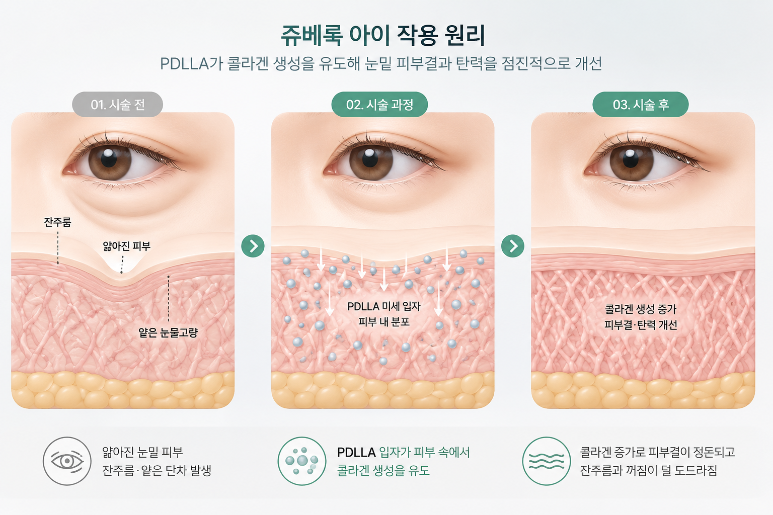 쥬베룩 아이 PDLLA 미세입자가 콜라겐 생성을 유도해 눈밑 피부결과 탄력을 보완하는 과정