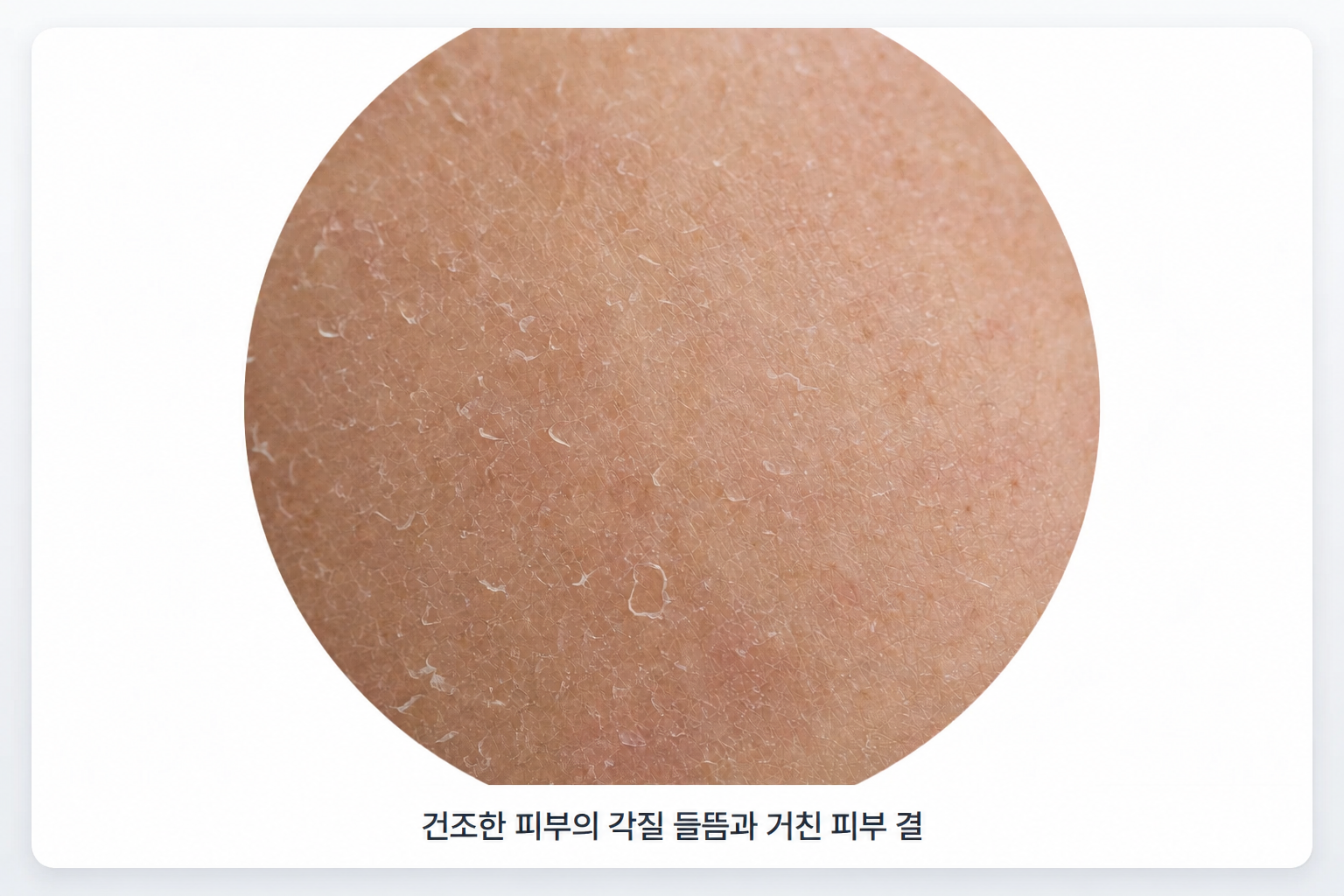 각질층의 수분 부족으로 하얀 각질이 들뜨고 미세한 잔주름과 거친 피부 결이 나타난 건조한 피부 표면