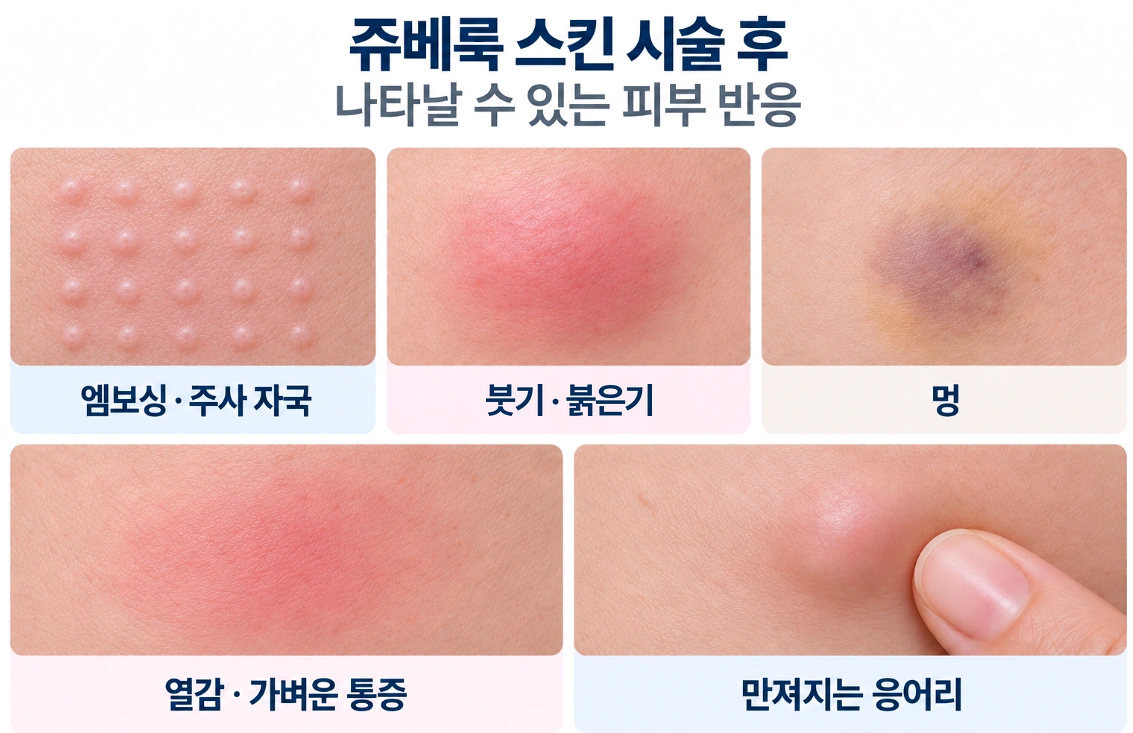 쥬베룩 스킨 시술 후 엠보싱·주사 자국·붓기·붉은기·멍·열감·통증·응어리 등 나타날 수 있는 반응을 정리한 비교 사진