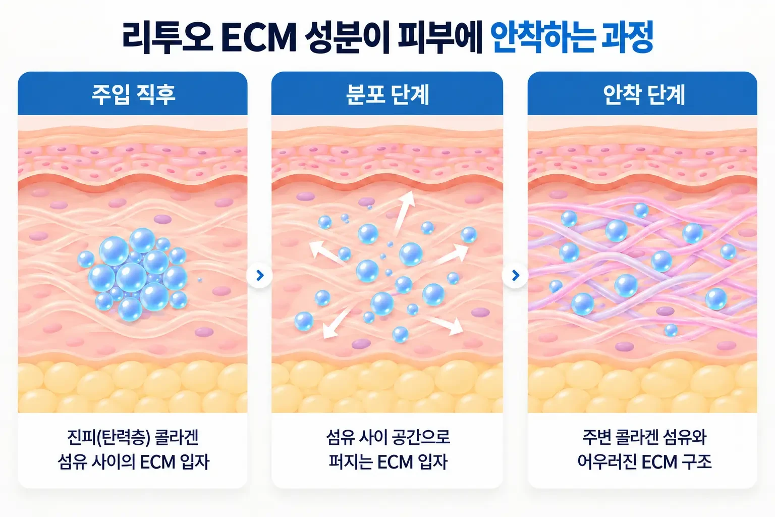 진피 콜라겐 섬유 사이로 리투오 ECM 입자가 퍼져 자리 잡는 과정을 단계별로 나타낸 확대 개념도