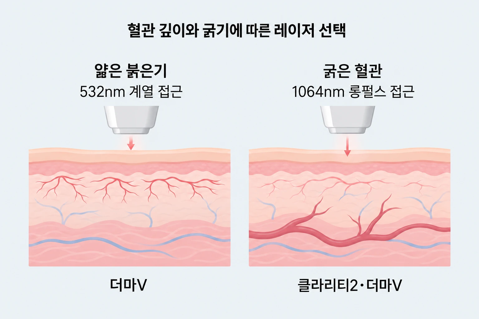 얕은 붉은기와 굵은 혈관에 따라 달라지는 레이저 파장 선택