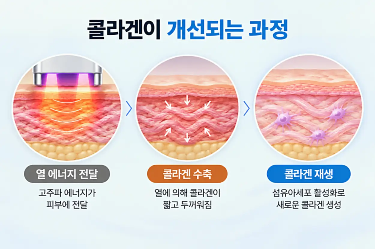 콜라겐 수축과 재생 반응이 나타나는 시점을 정리한 이미지
