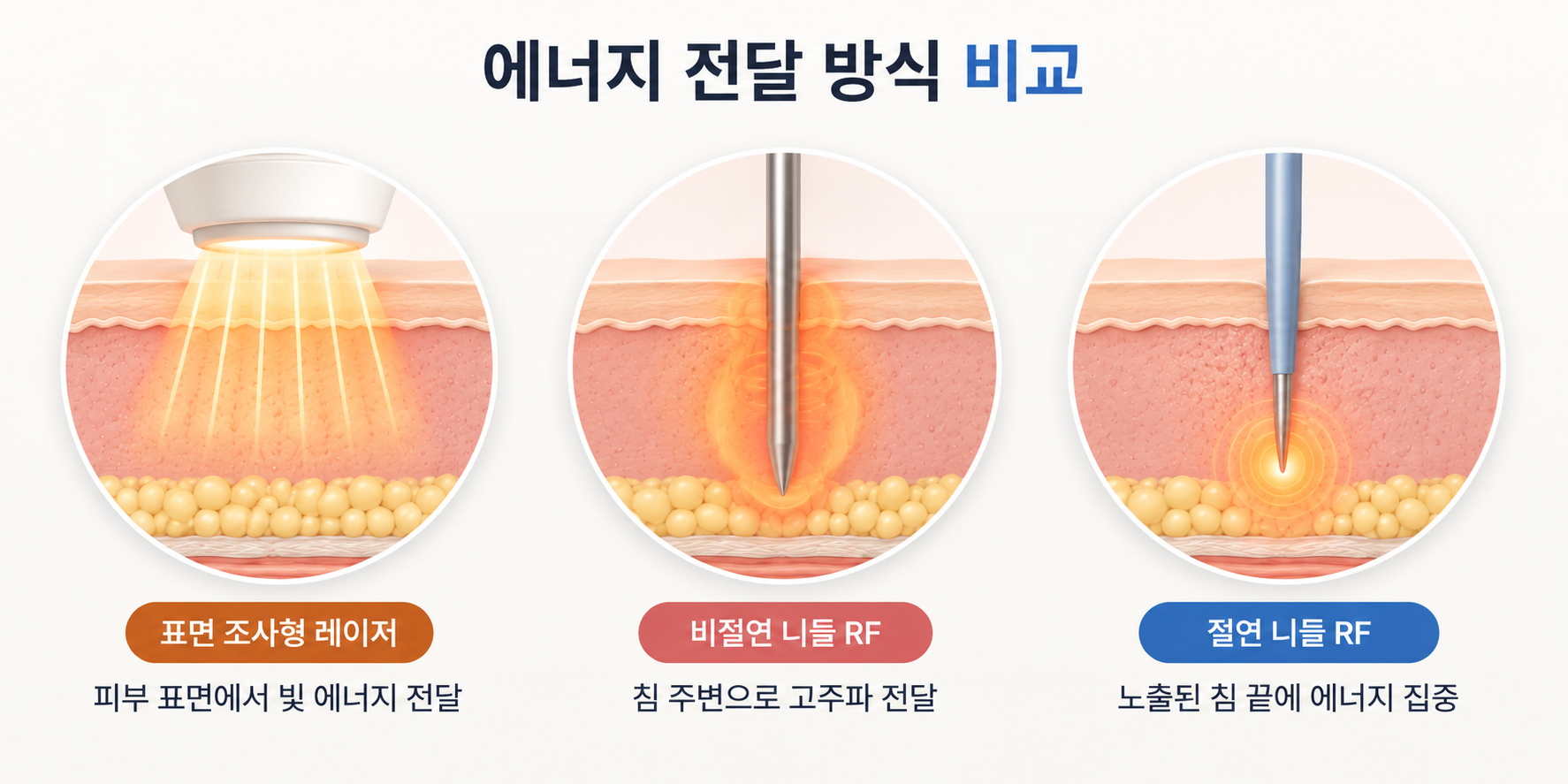표면 조사형 레이저와 비절연 니들 RF 절연 니들 RF 에너지 전달 방식 비교