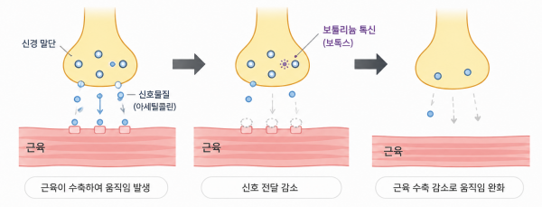 보툴리눔 톡신의 신경 신호 전달 감소와 근육 움직임 완화 과정