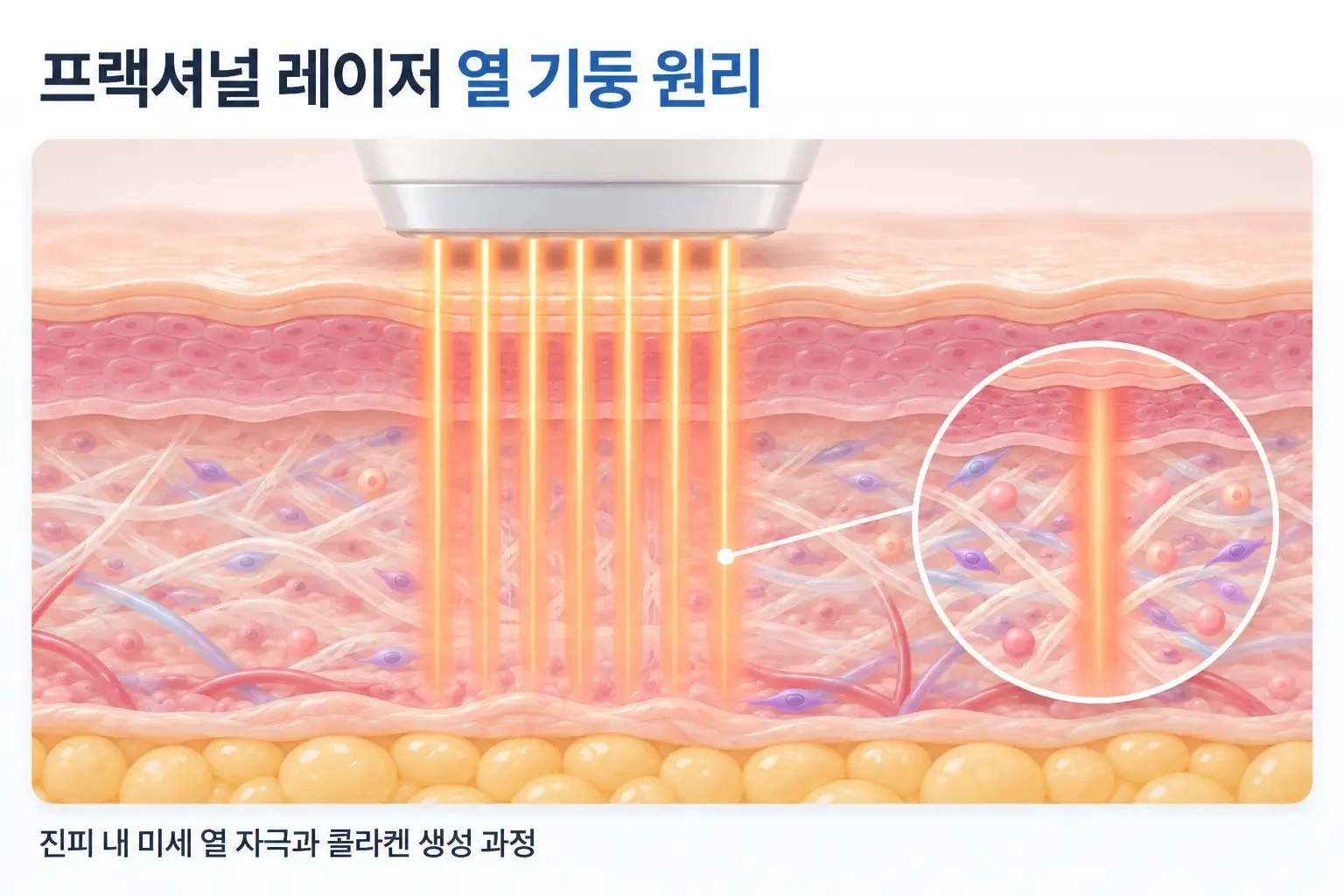 프랙셔널 레이저의 미세 열 기둥이 진피에 닿아 콜라겐이 생성되는 과정을 표현한 원리 일러스트