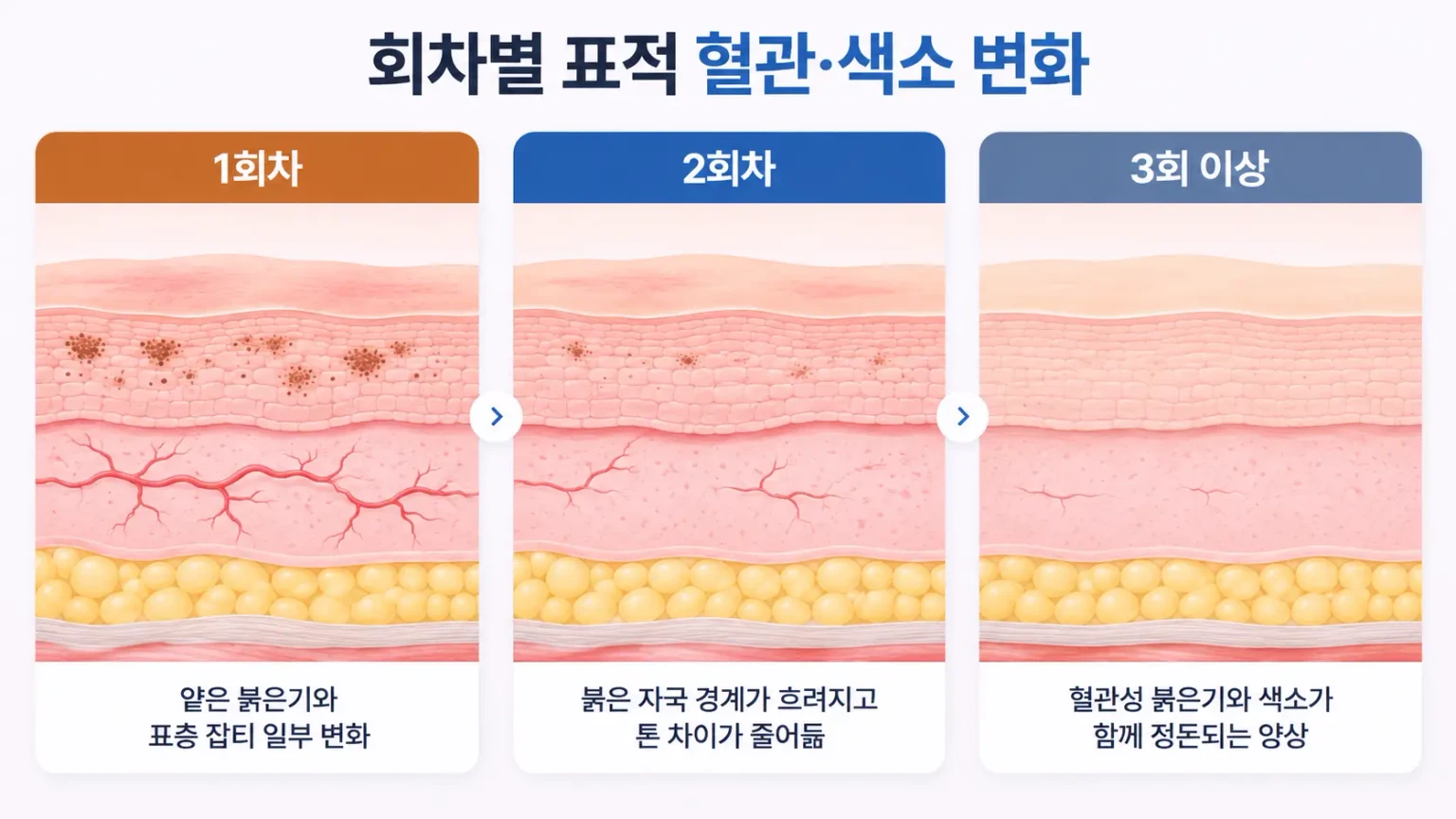 회차가 거듭되며 확장된 미세혈관과 멜라닌 색소가 줄어드는 과정을 같은 배율로 그린 피부 단면도