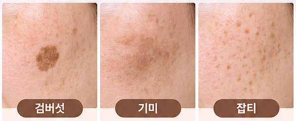 검버섯·기미·잡티의 색과 형태 차이