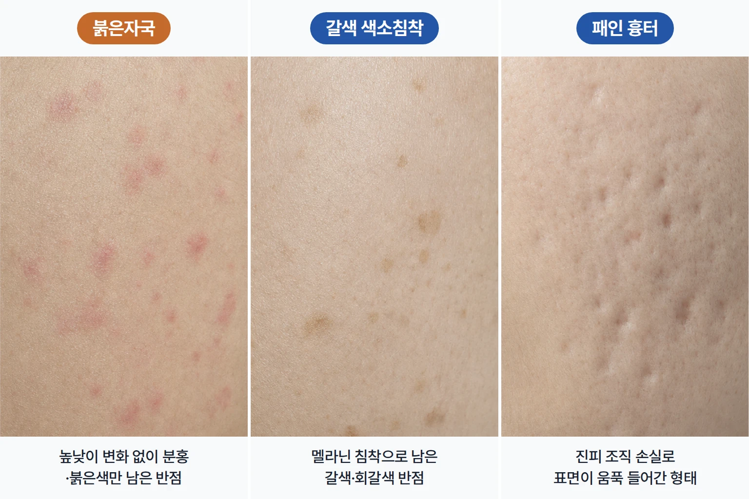 여드름 후 평평하게 남은 붉은 반점과 멜라닌 침착으로 생긴 갈색 자국, 진피 조직 손실로 표면이 움푹 들어간 패인 흉터 비교