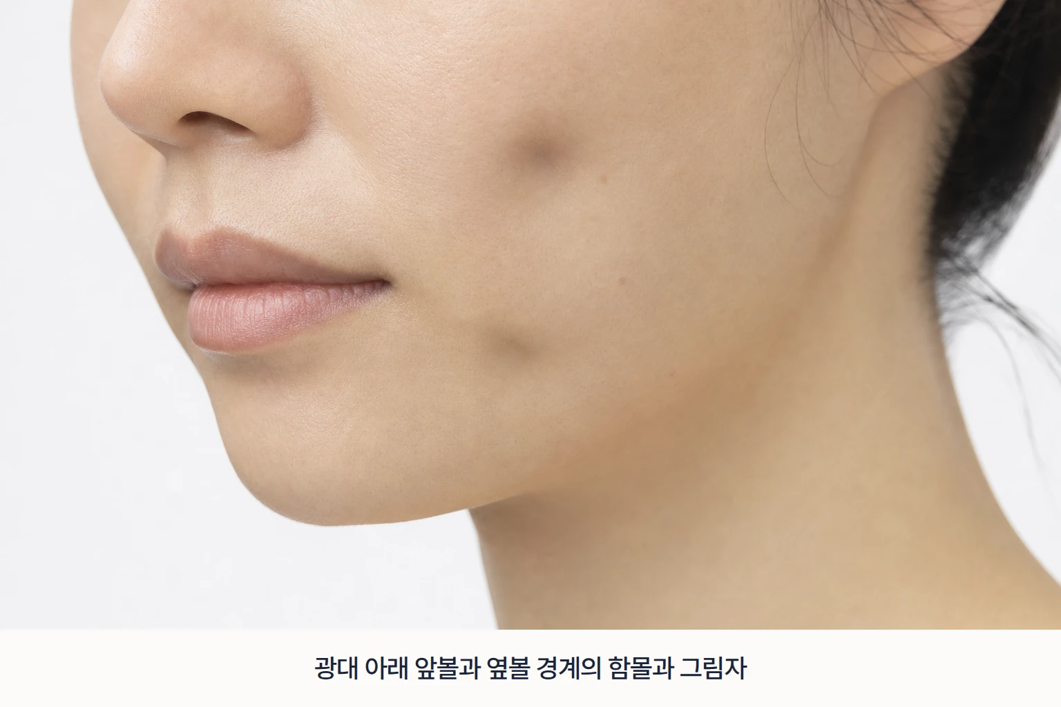 광대 아래 앞볼과 옆볼 경계에 나타난 볼패임과 음영