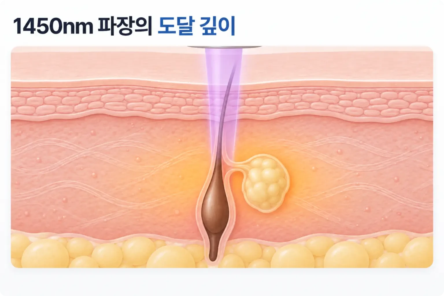 1450nm 레이저가 표피를 지나 진피 상부 피지선 주변에 열을 만드는 모습을 그린 피부 단면도