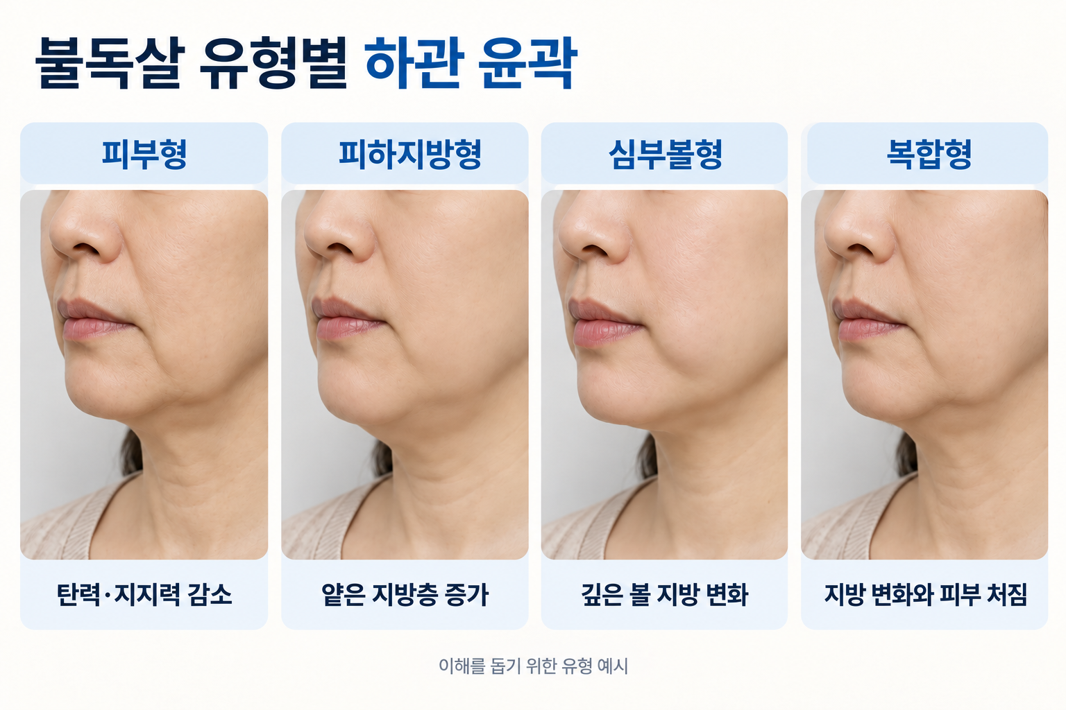불독살의 피부형, 피하지방형, 심부볼형, 복합형에 따른 하관 윤곽과 턱선 처짐 특징을 비교한 이미지