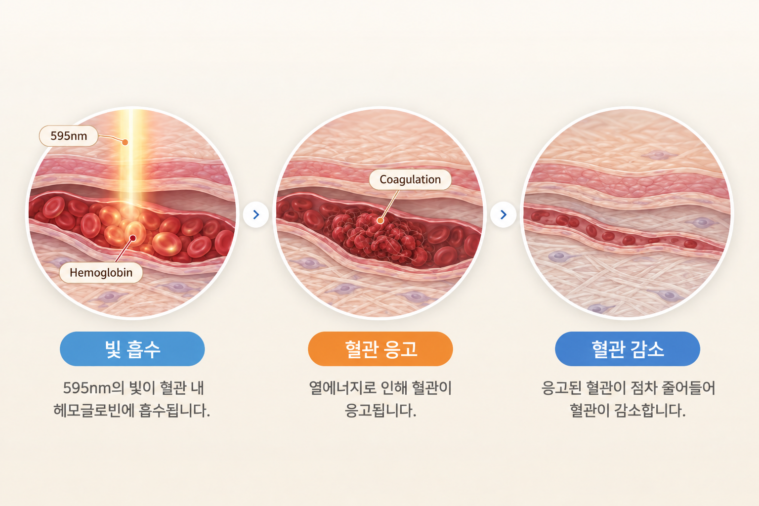 안면홍조 595nm 레이저의 헤모글로빈 흡수와 혈관 응고 과정