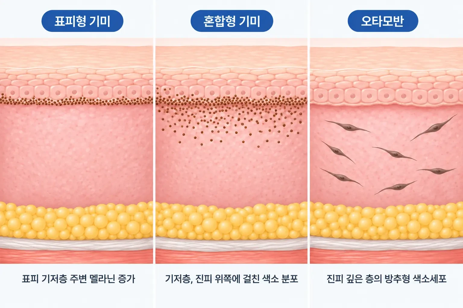 표피 기저층의 기미 멜라닌, 혼합형 기미, 진피 깊은 오타모반 색소세포 깊이를 비교한 단면도