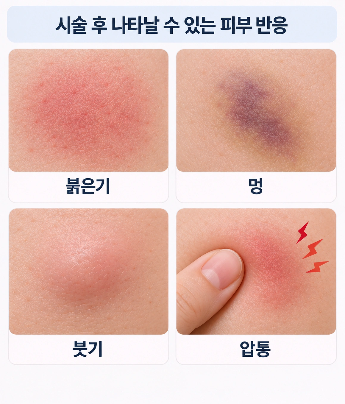 바디 인모드 시술 후 나타날 수 있는 붉은기·멍·붓기·압통