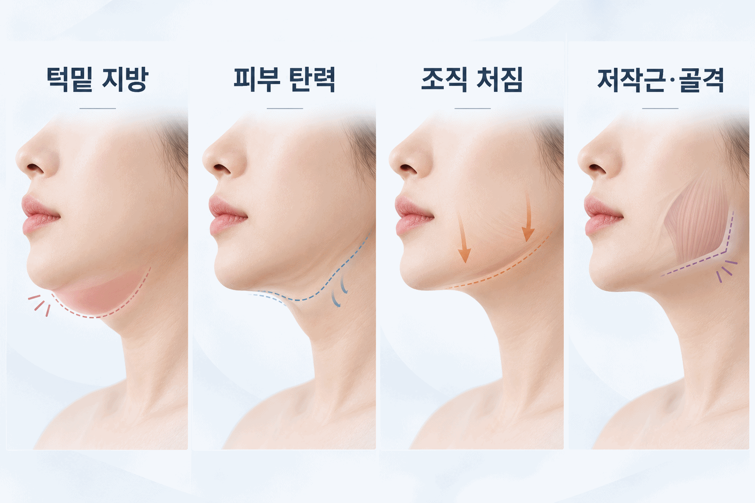 턱밑 지방, 피부 탄력 저하, 조직 처짐, 저작근과 골격에 따른 턱선 차이
