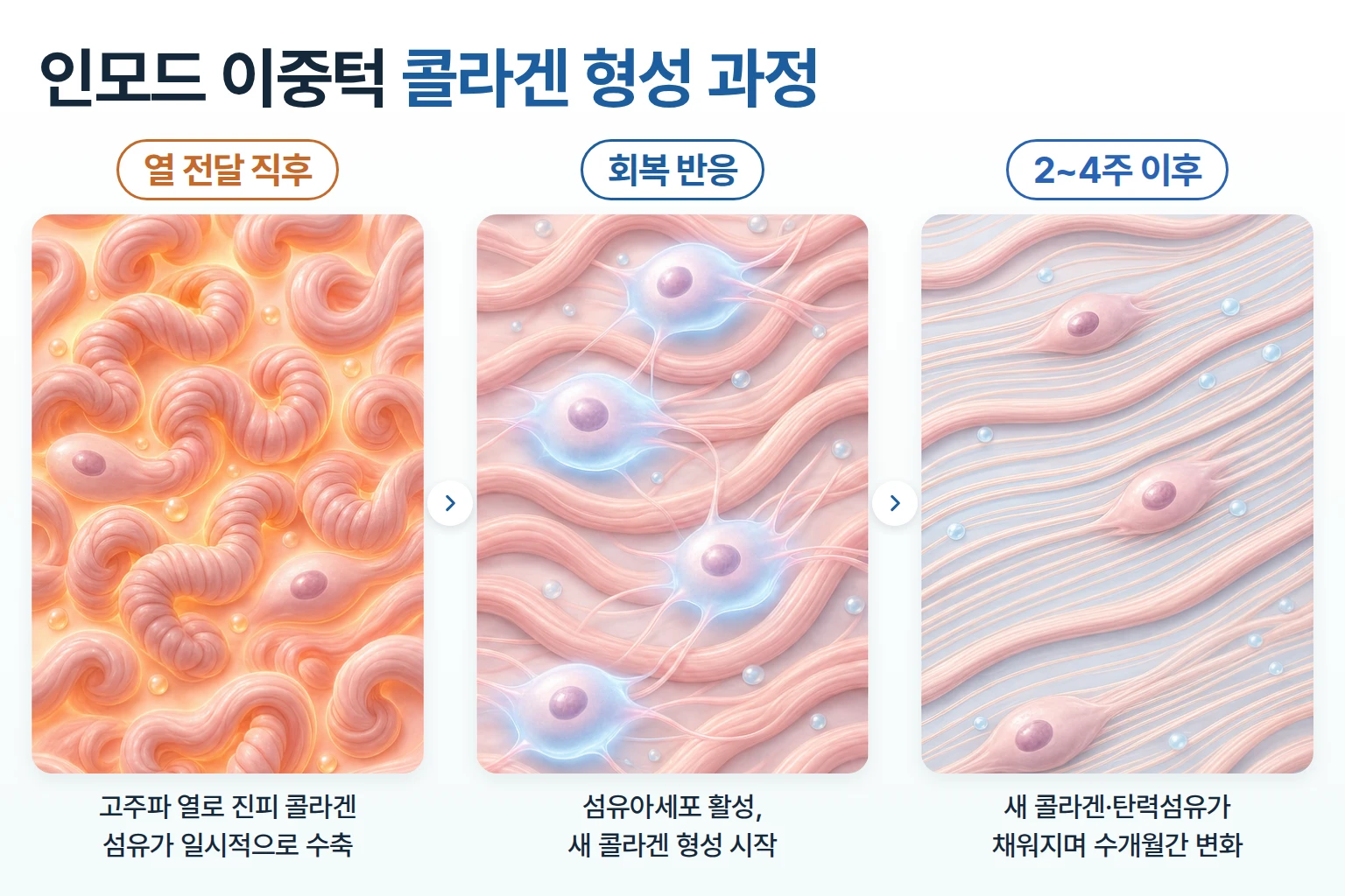 고주파 열에 의한 콜라겐 섬유 수축, 섬유아세포 활성, 새 콜라겐 형성을 단계별로 나타낸 개념도