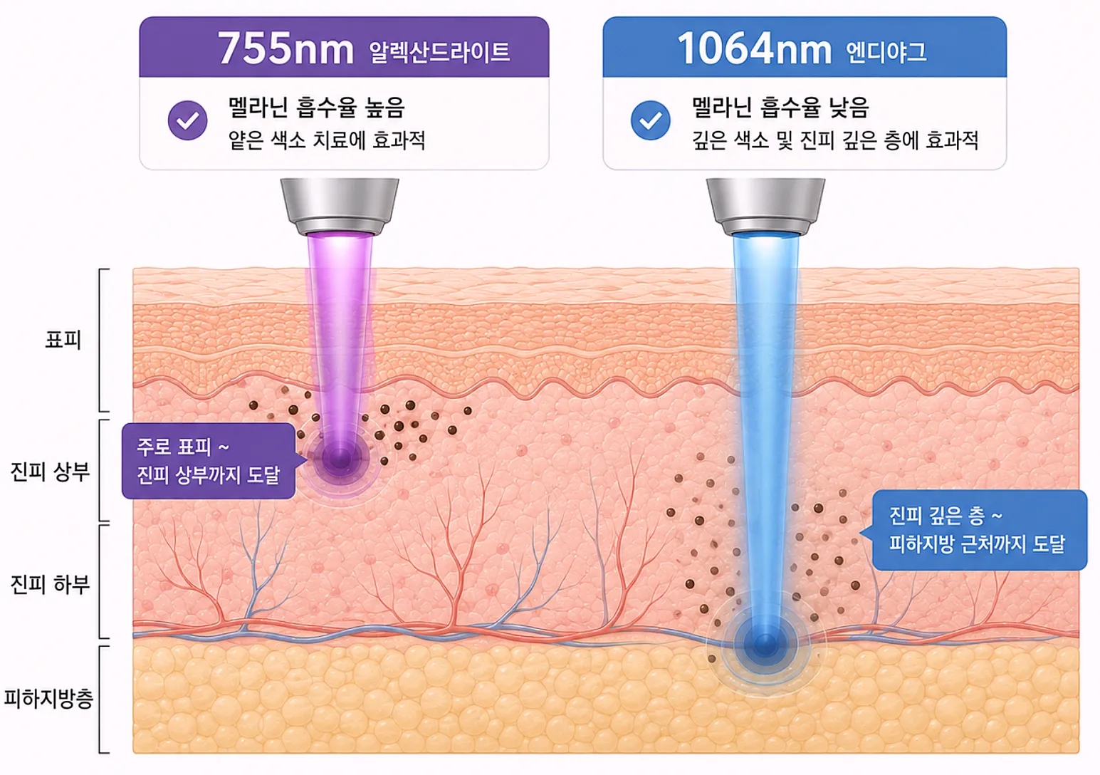 755nm 알렉산드라이트와 1064nm 엔디야그 파장 비교 단면도