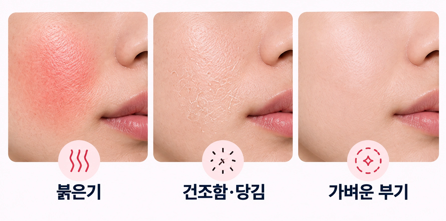 볼뉴머 리프팅 후 나타날 수 있는 붉은기와 건조함·당김, 가벼운 부기를 비교한 피부 반응 이미지