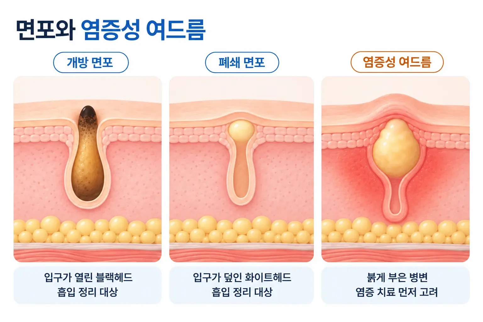 블랙헤드, 화이트헤드, 붉게 부은 염증성 여드름의 모공 속 상태를 비교한 피부 단면 일러스트