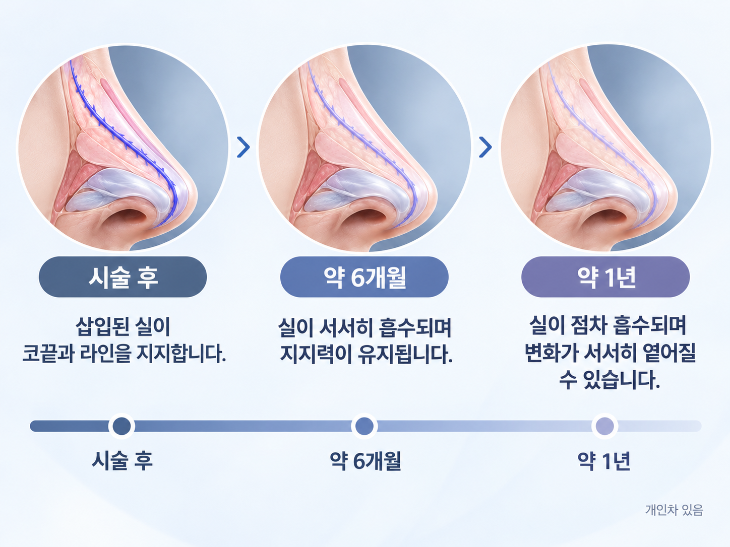 코 실리프팅 후 약 6개월에서 1년까지 흡수성 실의 변화와 유지기간 흐름