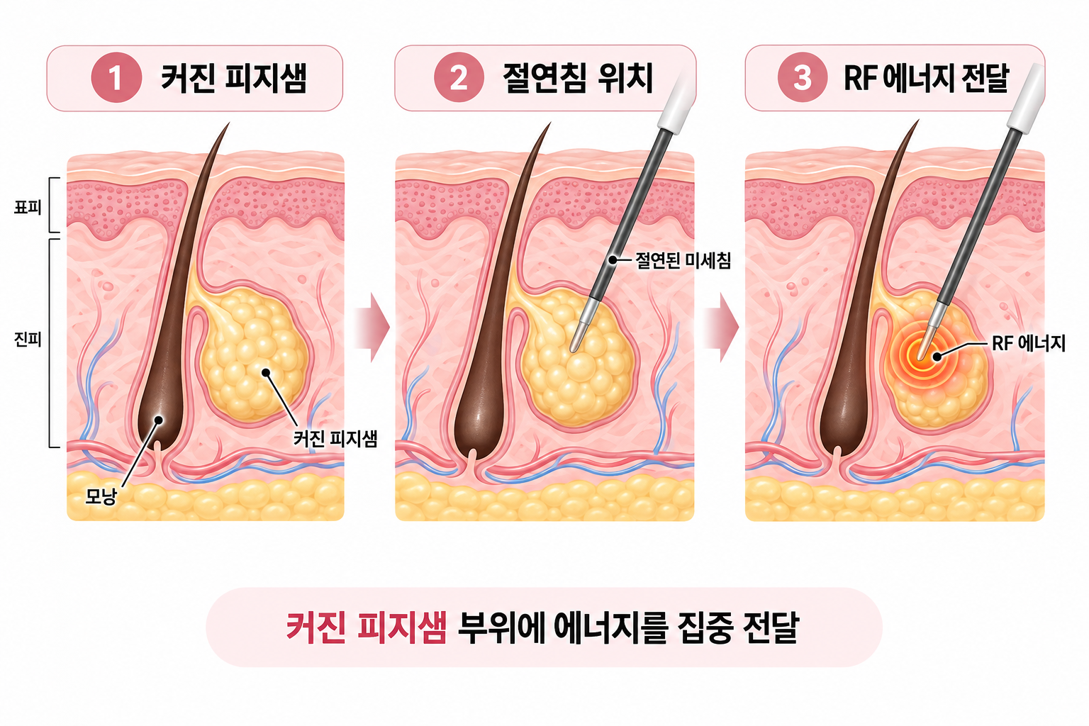 아그네스 절연침이 커진 피지샘에 고주파 에너지를 전달하는 피지선증식증 치료 원리