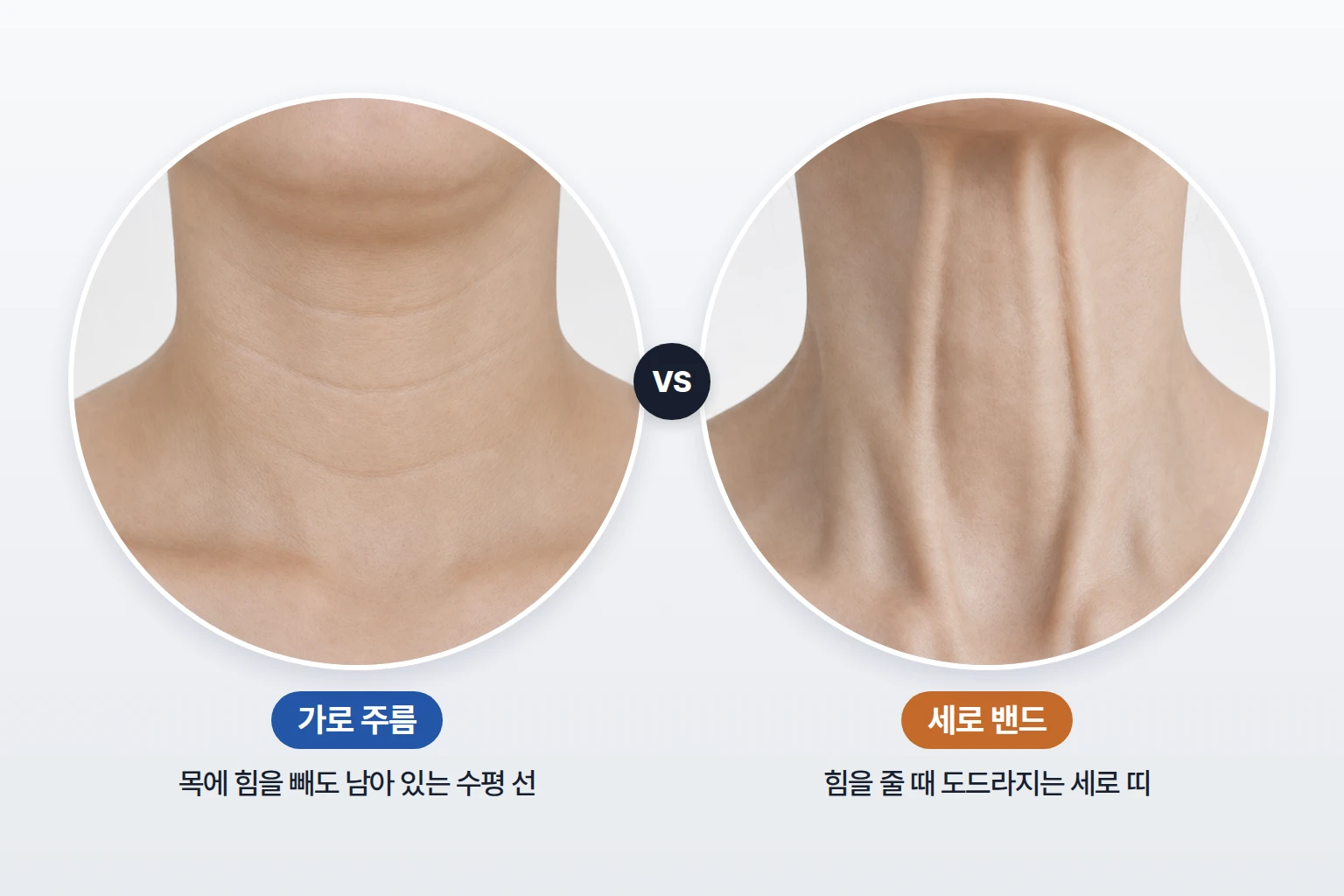가로 목주름과 세로 밴드의 형태와 움직임 차이 비교