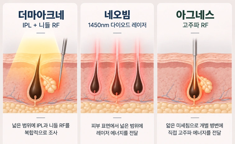 더마아크네·네오빔·아그네스의 여드름 치료 방식과 피지선 접근 차이를 비교한 이미지
