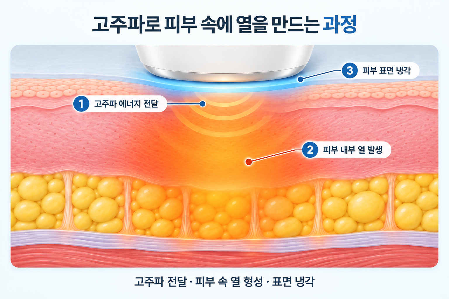 올타이트 리프팅 고주파 에너지 전달과 피부 내부 열 발생 및 표면 냉각 과정
