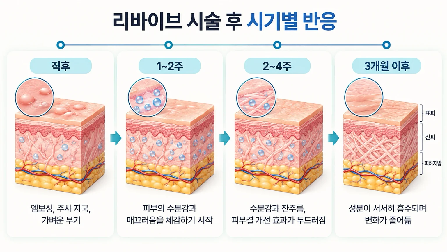 리바이브 스킨부스터 시술 직후 엠보싱부터 수개월 이후까지 시기별 피부 변화를 정리한 흐름