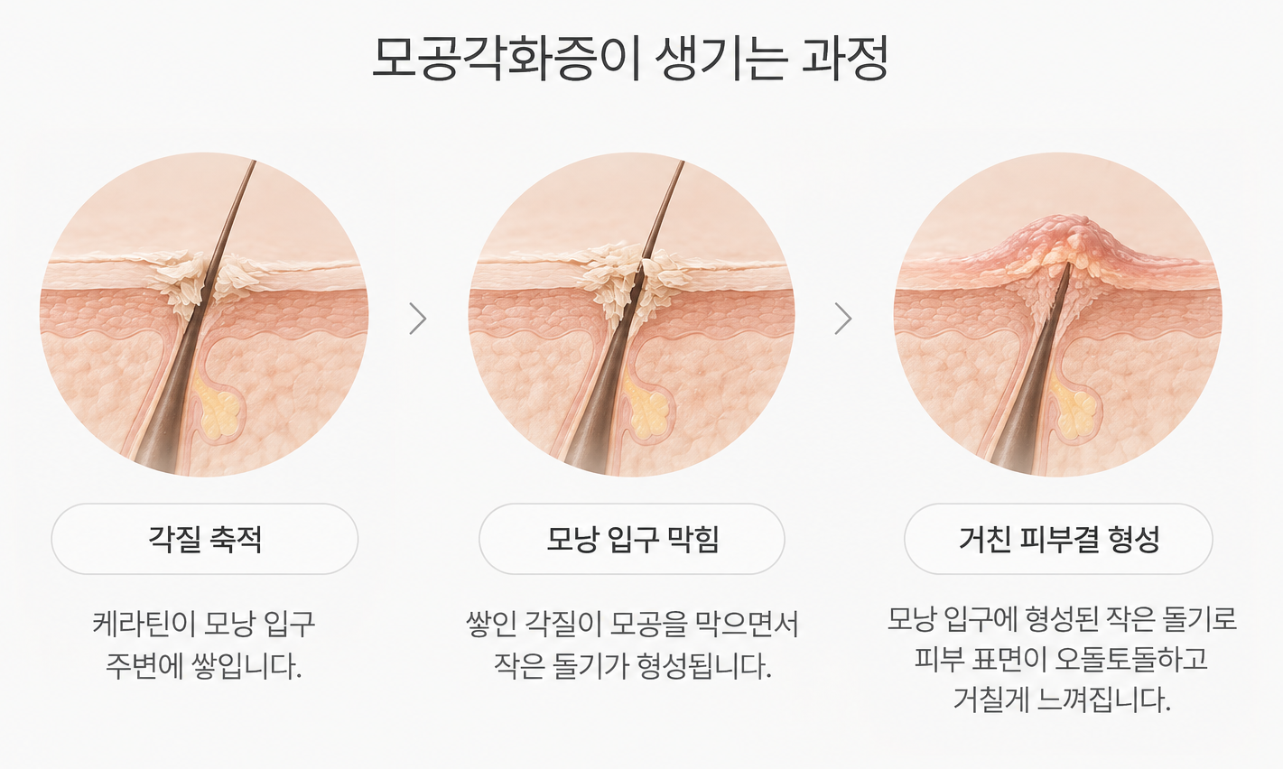 모낭 입구에 각질이 쌓여 거친 돌기가 형성되는 모공각화증 발생 과정